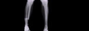 Football Tibia Fracture